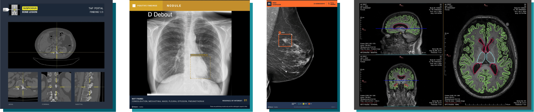 Logiciel de radiologie IA : le nouveau partenariat Gleamer x IMDEV - IMDEV